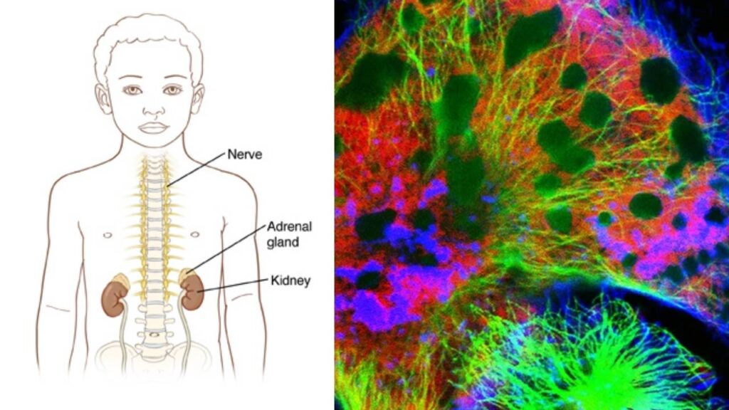 Child Who Received CAR-T Cancer Therapy Remains Disease-Free 18 Years Later 2 Neuroblastoma