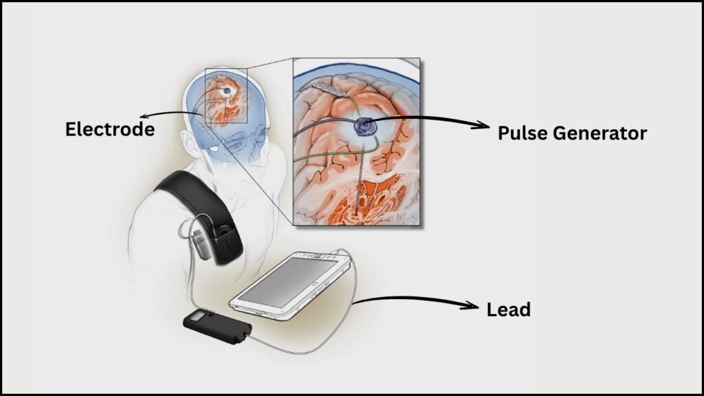 Smart Brain Implants Show Promise in Transforming Parkinson’s Disease Treatment 3 Adaptive Deep Brain Stimulation (aDBS)