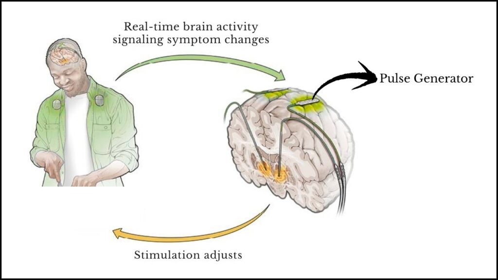 Smart Brain Implants Show Promise in Transforming Parkinson’s Disease Treatment 4 How Does aDBS Work in Real Life