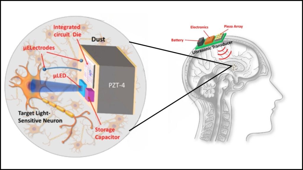 Smart Brain Implants Show Promise in Transforming Parkinson’s Disease Treatment 2 Parkinson’s Disease Treatment