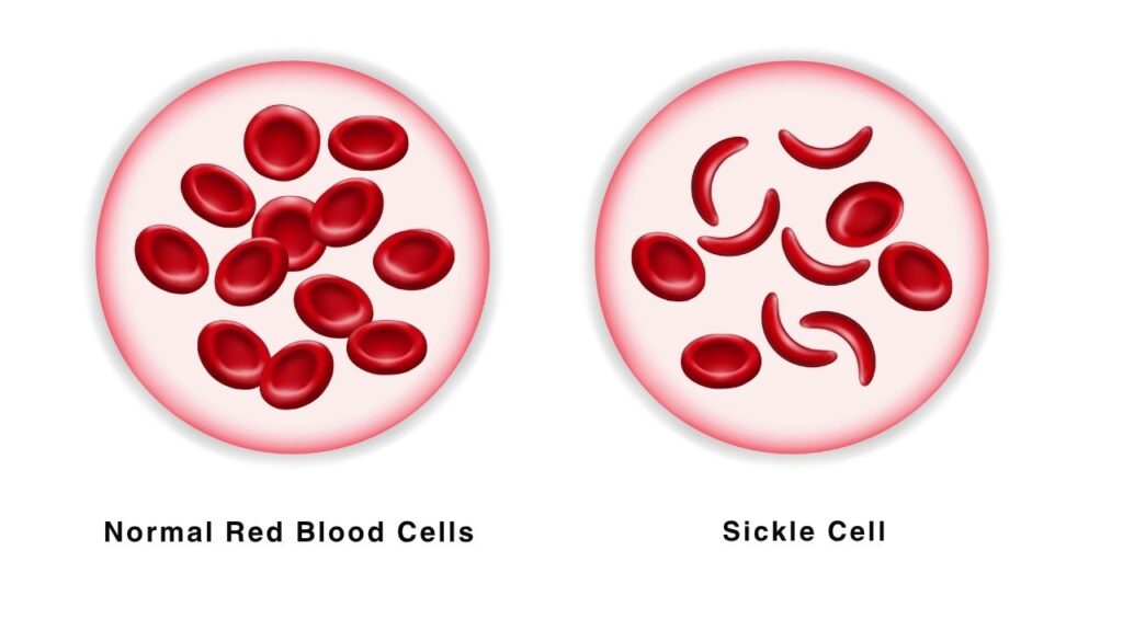 New Genetic Discovery Could Unlock Powerful Breakthroughs in Disease Treatment 2 Sickle Cell Disease