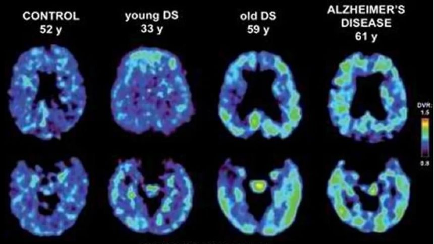 Brain Scans Reveal What Really Happens When Your Mind Goes Blank — And It’s Like Deep Sleep 3 Why Does the Mind Go Blank