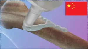 Revolutionary ‘Bone Glue’ Heals Fractures in 3 Minutes – No Surgery, No Metal Implants Needed 9 Revolutionary ‘Bone Glue’ Heals Fractures in 3 Minutes