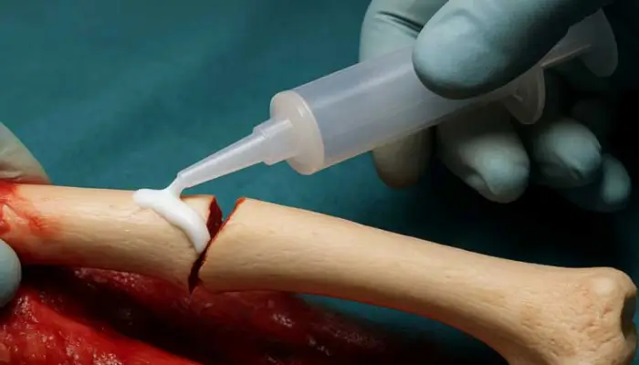 Revolutionary ‘Bone Glue’